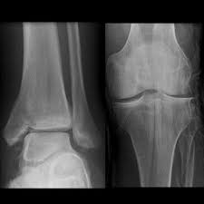 Maisonneuve fracture is a fracture of the proximal third of the fibula resulting from forced external rotation of the foot.1 many authors consider maisonneuve injury to be one of the most unstable. Eponymous Ankle And Talus Injuries Litfl Eponymythology