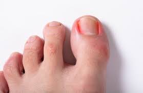 ingrown toenail the frankel foot