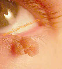 cosmetic eyelid surgery oculo