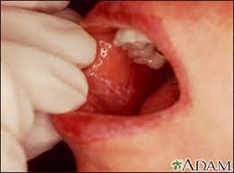 mouth ulcers information mount sinai