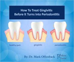 seek gingivitis treatment before it