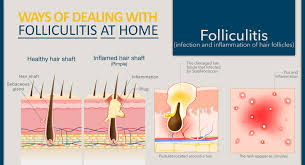 8 folliculitis home treatment options