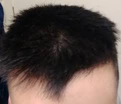 Scalp Completely Visible Under Light 20 Years Old Advice