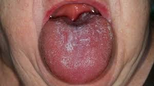Candidiasis in the mouth, throat, or esophagus is uncommon in healthy adults. Candidose Der Mundschleimhaut Altmeyers Enzyklopadie Fachbereich Dermatologie