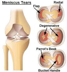 meniscus tear treatment options knee