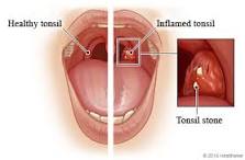 Do doctors remove tonsil stones?