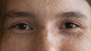 wrinkles on the upper eyelid natural