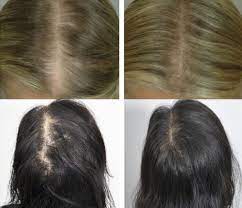 hair loss treatments in toronto