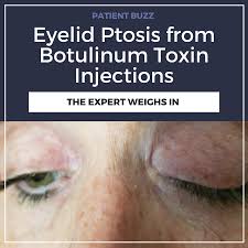eyelid ptosis from botulinum toxin