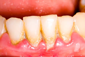 gingivitis periodonis symptoms