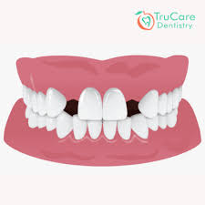 Fortunately, it is possible to use invisalign for treating gaps in the teeth. Are You Worried About A Gap Between Teeth Here S A List Of Best Treatment Options Trucare Dentistry Roswell