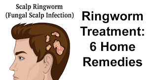 ringworm treatment 6 home remes