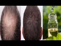 Mix it well and massage the mixture onto the scalp. How Tea Tree Oil Can Promote Rapid Hair Growth Youtube