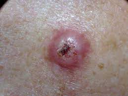 squamous cell carcinoma symptoms