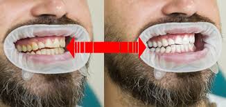 tooth whitening 6 myths advanced