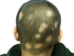 alopecia areata hair loss symptoms