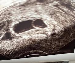 Ssw im ultraschall noch nichts spannendes zu sehen ist, so durchläuft ihr körper dennoch viele veränderungen. 8 Ssw Dottersack Kein Embryo Zu Sehen Kinder Schwangerschaft Frauenarzt