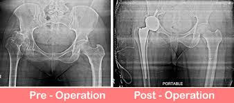 best hip replacement surgery hospital