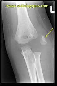Learn about epicondyle of humerus with free interactive flashcards. Avulsion Fracture Elbow Page 1 Line 17qq Com