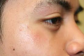 eyelid dermais xeroderma of the