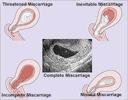 what to do after a miscarriage