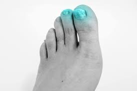 thickened toenails mississauga foot