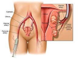 uterine fibroids varicose veins