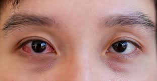 pink eye vs allergies how to tell the