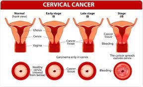 A pap smear can help detect changes in the cervix caused by hpv. Hpv And Cervical Cancer