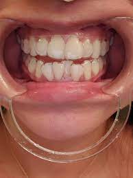 To determine exactly how long the retainer must be used, it is important to schedule follow up visits. A Pic So You Can See How The Byte Aligners Fit Smiledirectclub