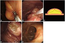 endoscopic resection of a giant colon