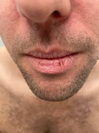 dry lips this winter goldman dermatology