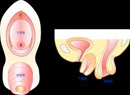 子宮脱と直腸脱の合併例