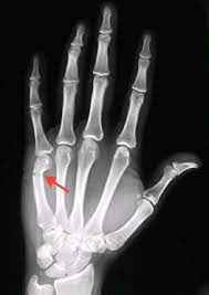 boxers fracture symptoms treatment