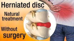 how to heal a herniated disc naturally