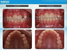 They are cosmetically abnormal and cause several other problems for the. Myobrace The Answer To Straightening Teeth Naturally Luminous Dentistry
