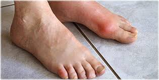 Common Symptoms of Gout: AllCare Foot & Ankle Center: Podiatry