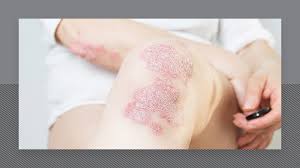 safe to have laser if i have psoriasis