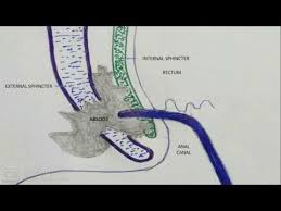 internal drainage of peri abscesses