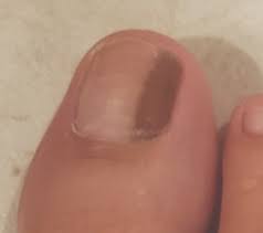 dark lines on toenails seattle foot