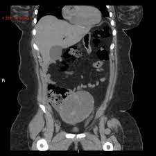 The differential diagnosis for abdominal pain is broad, encompassing gastrointestinal, gynecologic, urologic, vascular, and musculoskeletal conditions. Ct Of The Abdomen Pelvis Cedars Sinai