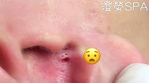 To view this video please enable javascript, and consider upgrading to a web browser that supports html5 video. Best Blackhead Popping And Removal Videos Of 2018 Insider