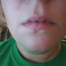 i have what looks like philtrum lines
