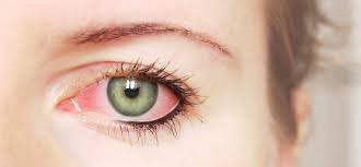 Apabila bawah mata kanan bergerak, otot kelopak mata anda (dikenali sebagai orbicularis oculi) sedang alami kekejangan, jelas dr. 11 Penyebab Mata Sakit Saat Berkedip