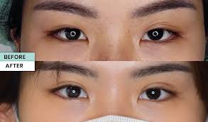 mengenal double eyelid treatment untuk