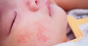 allergic reaction in baby treatment
