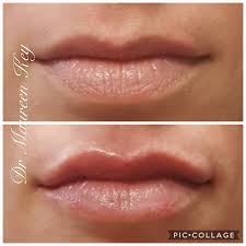 lip flip on full lips with filler in