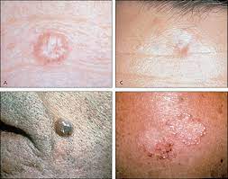 Sometimes skin cancer may arise at relatively concealed places, such as inside your mouth, around your genitals, or under a nail. Early Detection And Treatment Of Skin Cancer American Family Physician