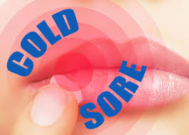 identifying treating cold sores in