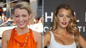 blake lively plastic surgery a